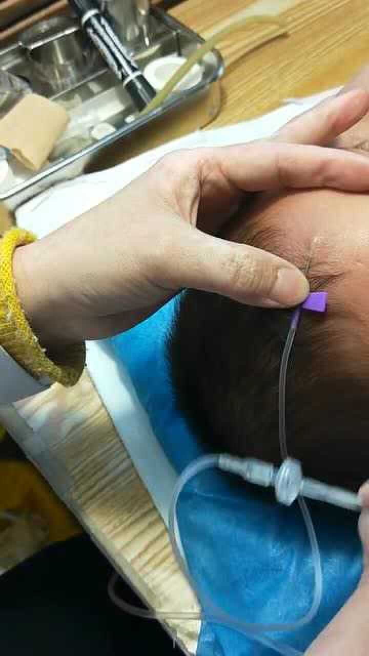 儿科护士常见扎针方法头皮针真的挺难扎能理解这职位的人吗