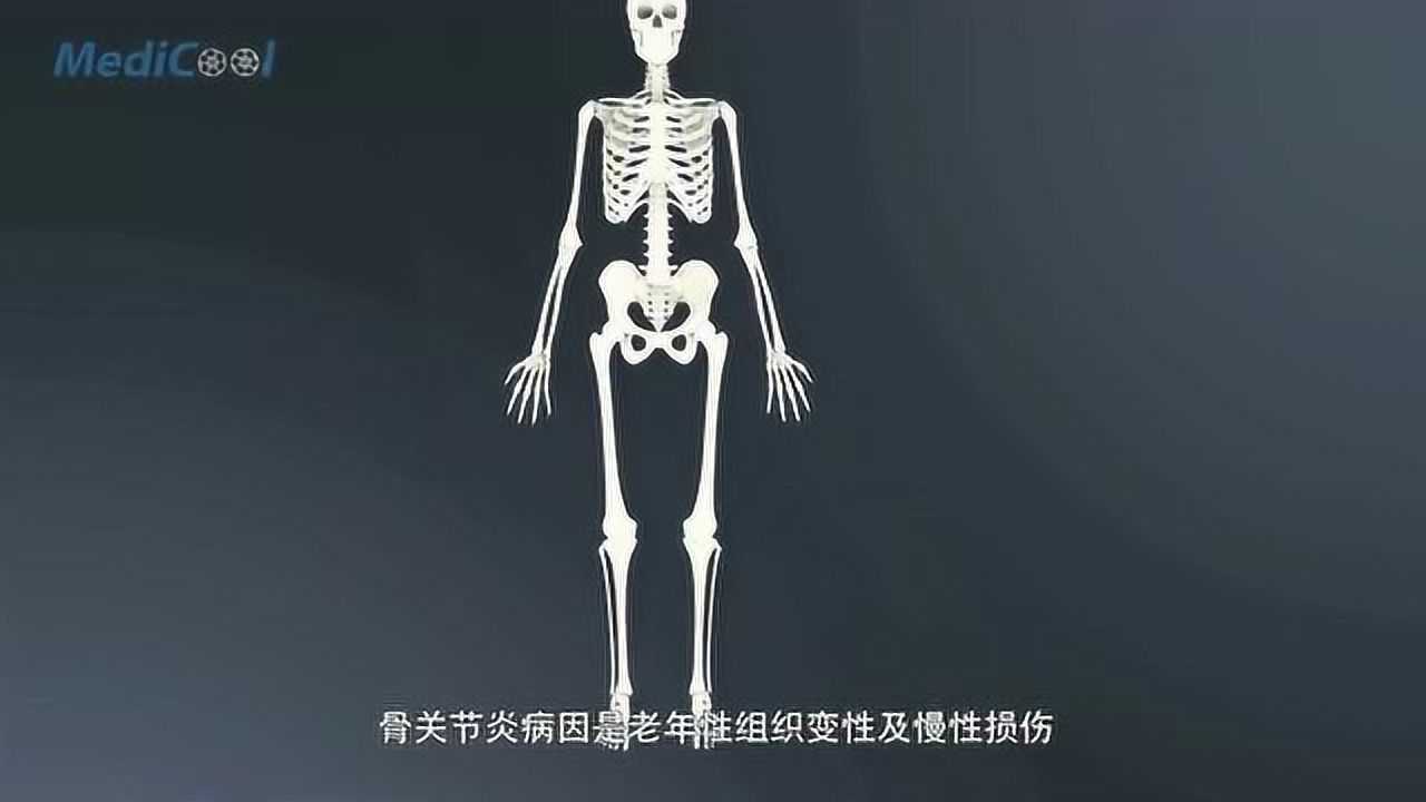 现场演示膝关节置换手术全过程老年人骨关节的治疗方法