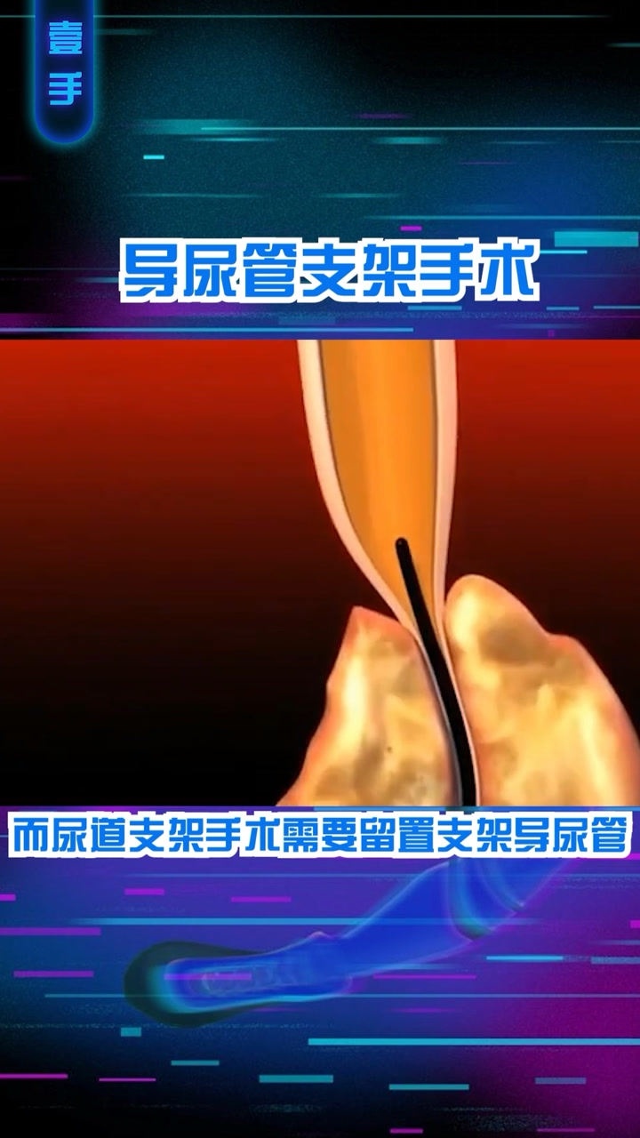 3D医学视频：导尿管支架手术！_腾讯视频