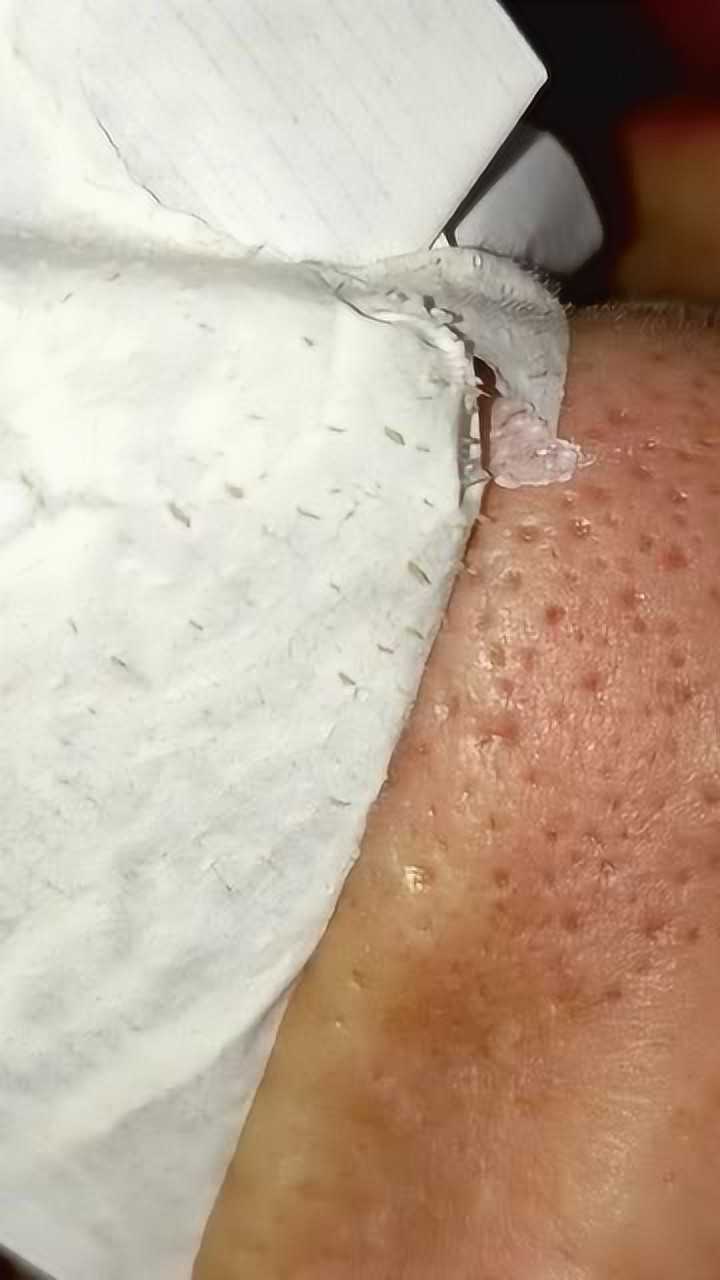 黑头粉刺螨虫什么的统统拉出来太过瘾了