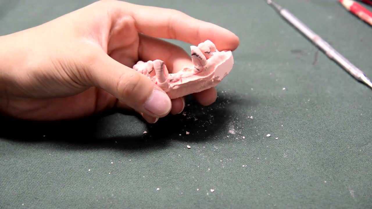 可摘局部义齿教学视频（上）_高清