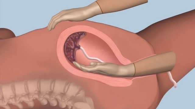 比顺产还疼10倍的“手剥胎盘”,到底是什么,让女性永生难忘!