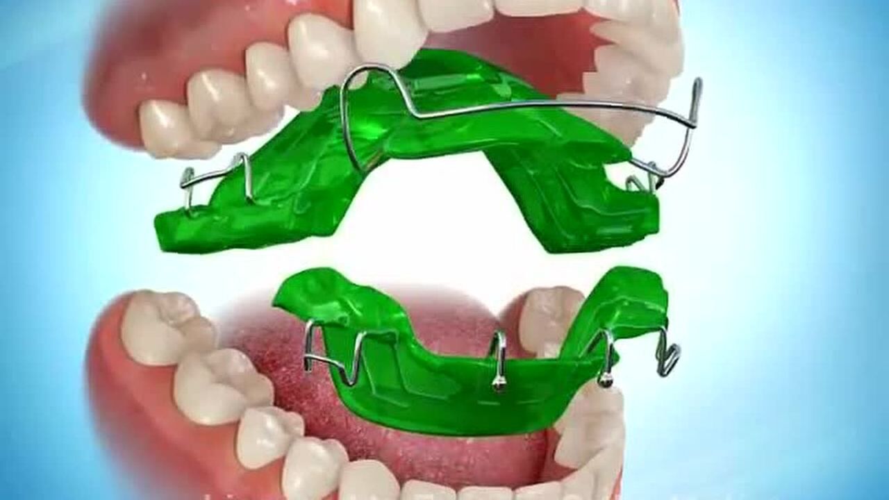 正畸活动矫治器