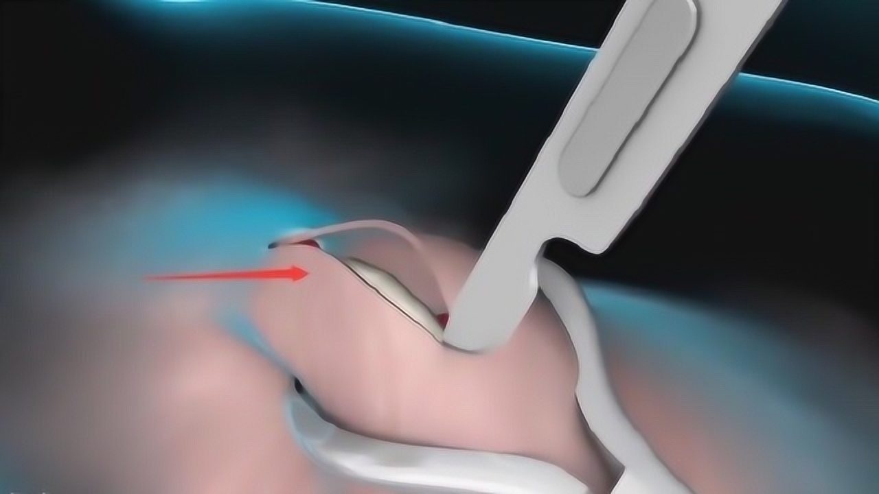 男性做结扎手术会经历啥3d动画揭晓答案看完裤裆一凉