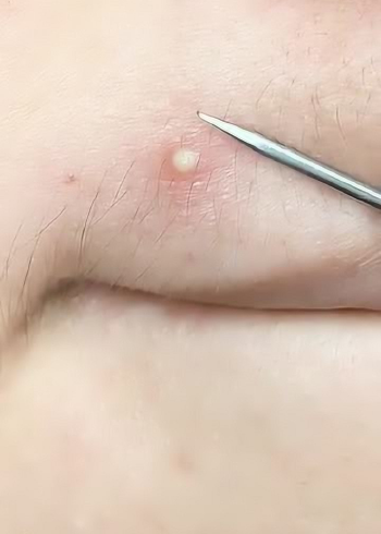 脓包痘痘是怎样形成的