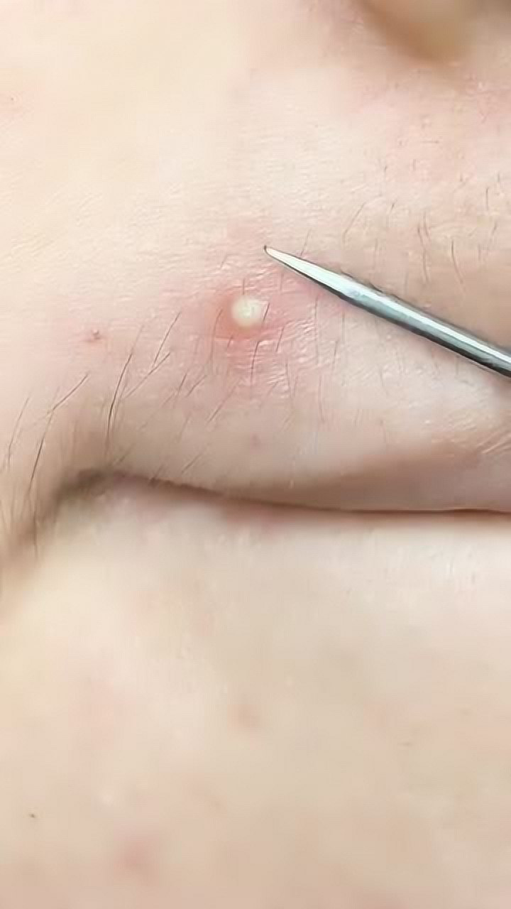 脓包痘痘是怎样形成的