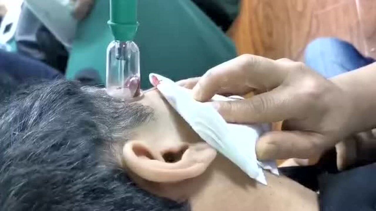 王合民太阳穴放血治疗头疼头晕大椎穴放血治疗颈椎病富贵包