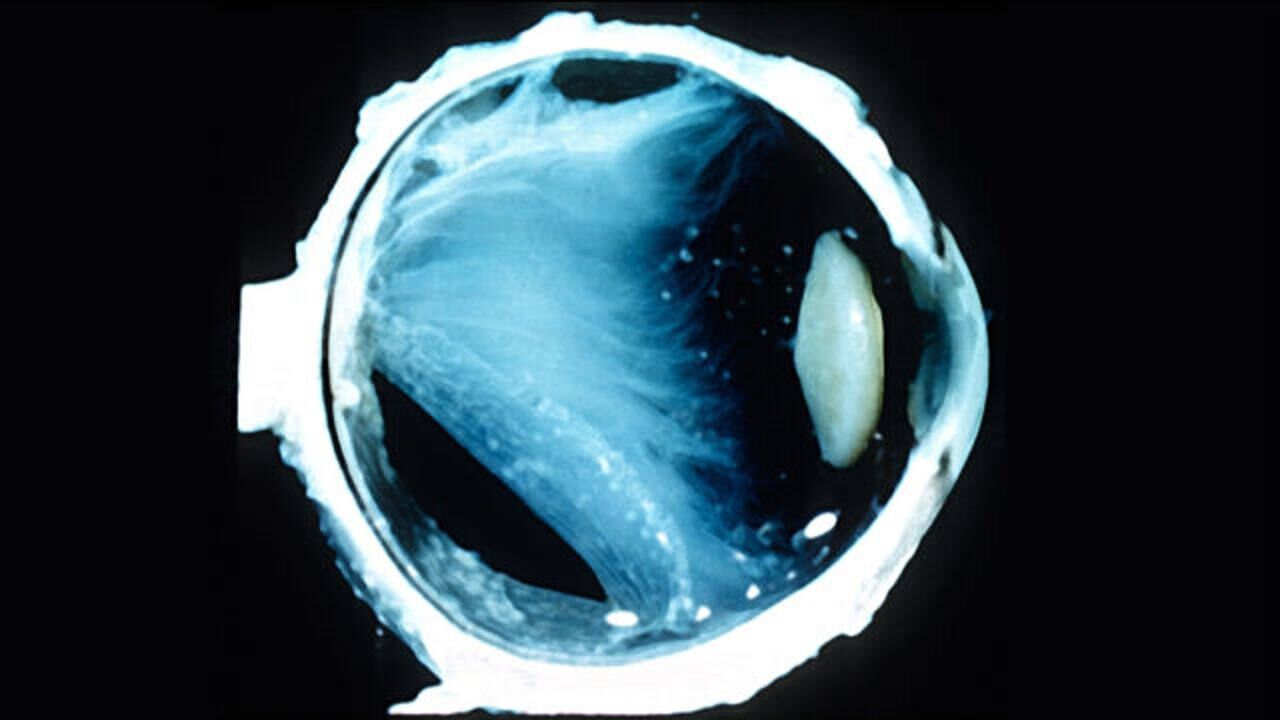 眼睛突然出现飞蚊症是什么原因引起的