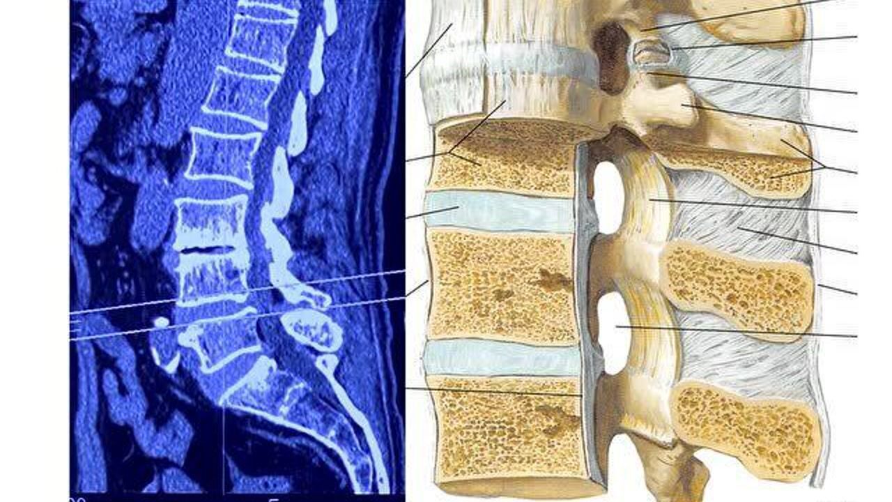 二张图片的对比教你读懂腰椎ct