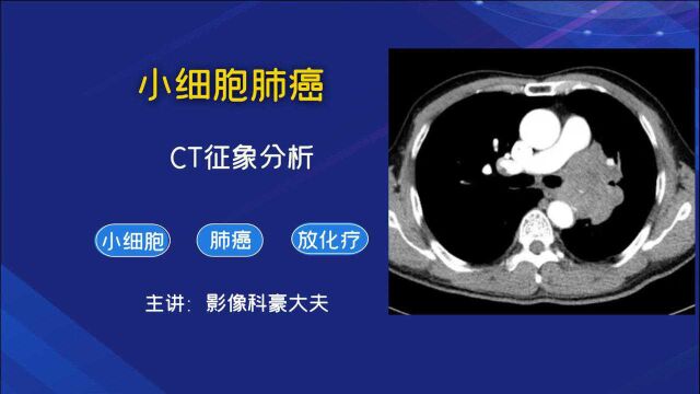 小细胞肺癌,带瘤生存3.5年,优质病例分享