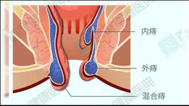 为什么会长痔疮,怎么判断自己是否得了痔疮?有了痔疮该怎么办呢