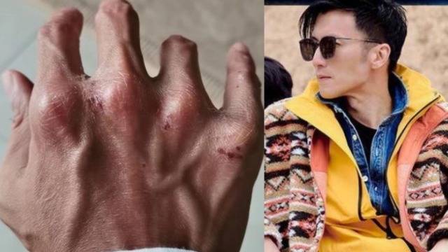 41岁谢霆锋晒伤痕累累的手,指节变形严重布满伤痕,网友直呼太心疼