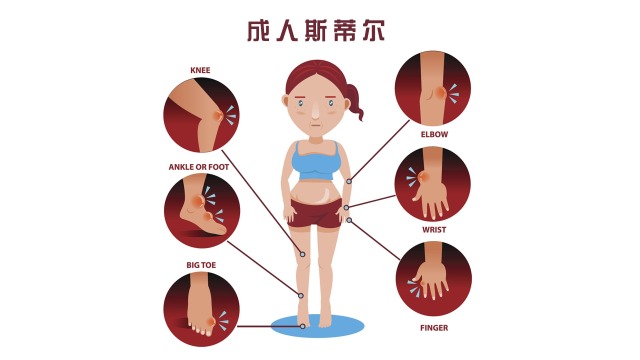 系统型起病的幼年型关节炎-成人斯蒂尔