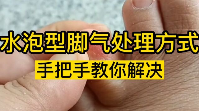 水泡型脚气如何处理?简单两步摆脱脚上长水泡发痒