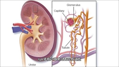 iga肾病六种常见表现有这些
