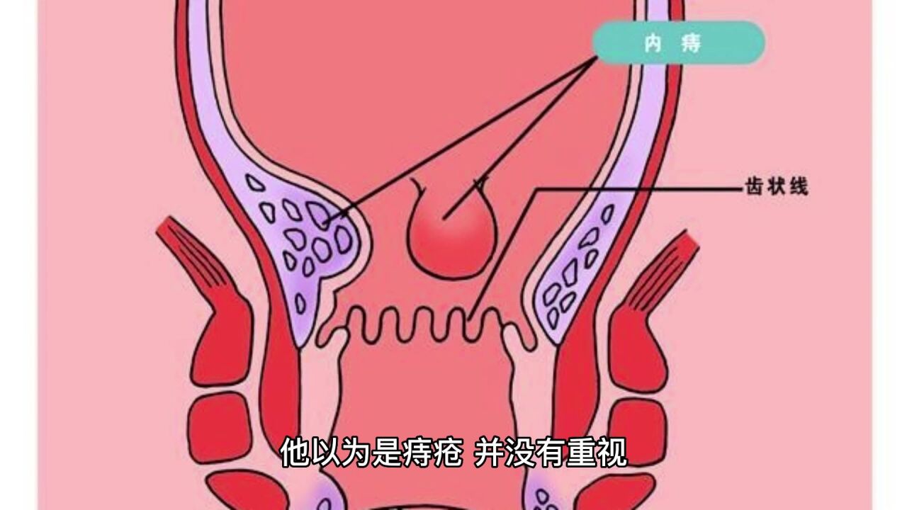 肛门癌来临,身体会出现4个症状!中老年人别大意了