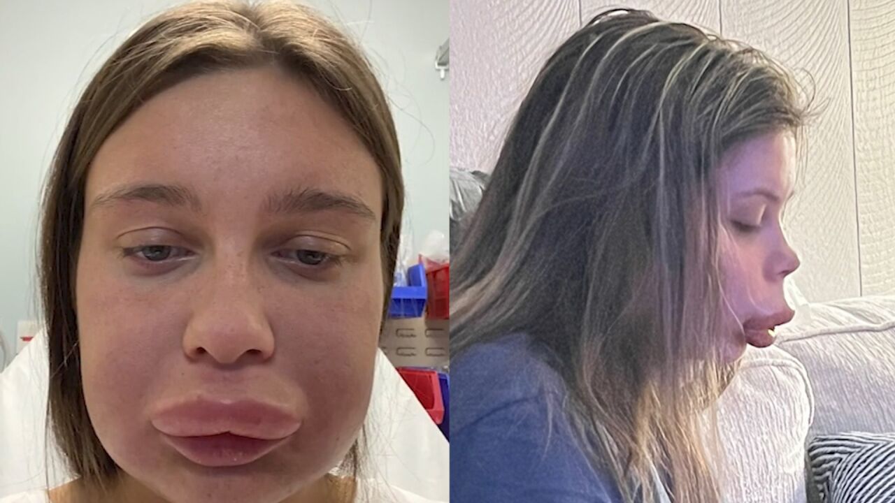 美女贪便宜半价丰唇,结果过敏肿胀成"香肠嘴",从此不敢碰针头