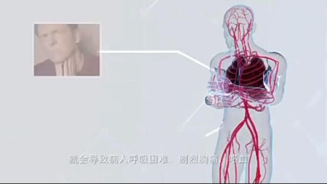 VTE的预防