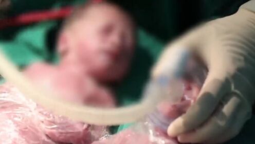 31周双胞胎宫内缺血缺氧，二宝脐带绕颈，出生后没有哭声