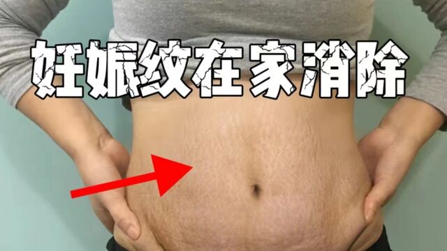 多年妊娠纹终于消除!原来方法这么简单!用过的人都好了!