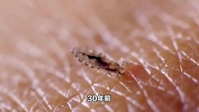 虱子消失之谜:从猖狂到无影无踪的头虱变迁