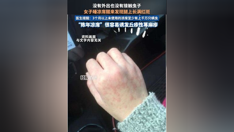 螨虫过敏怎么办图片