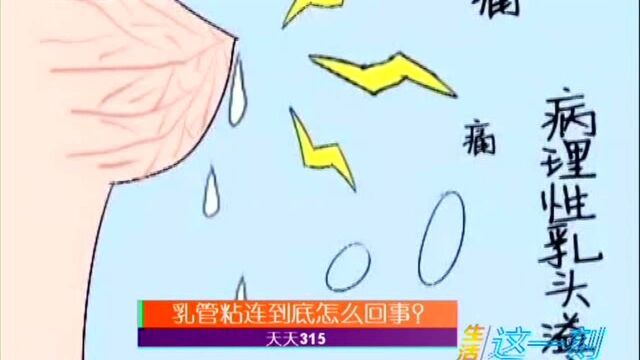 乳管粘连到底怎么回事?天天315