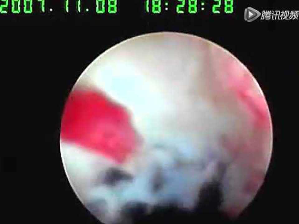 取环术_腾讯视频