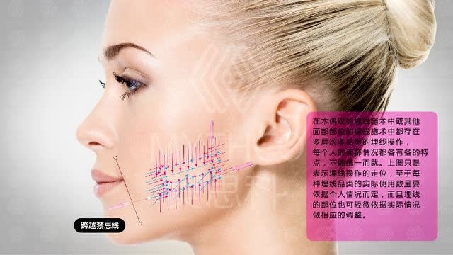 蛋白线 木偶纹 线雕 美思科