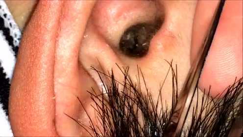 掏耳朵视频如何清除耳朵内的大块耳垢看得好过瘾