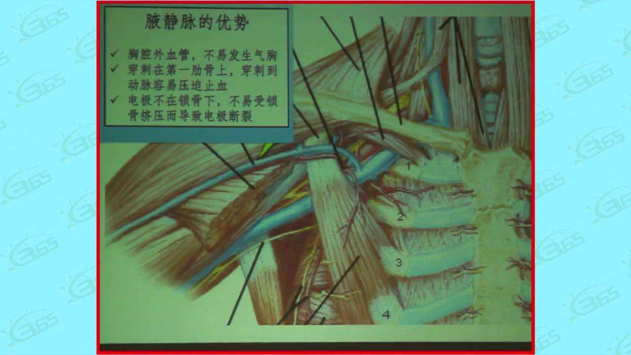 李剑明:腋静脉穿刺技术的解剖学基础和实践经_高清1080P在线观看平台_腾讯视频