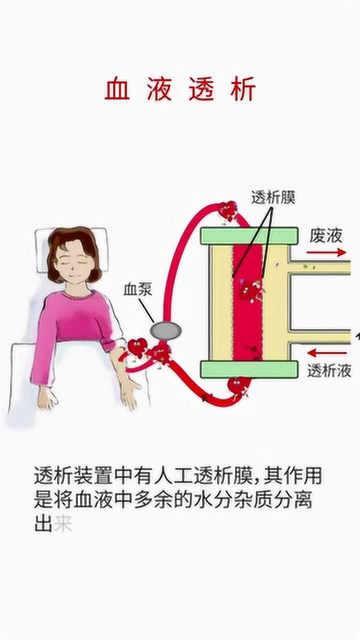 养父自制透析室救女_血液透析的工作流程!太有趣了_高清1080P在线观看平台_腾讯视频