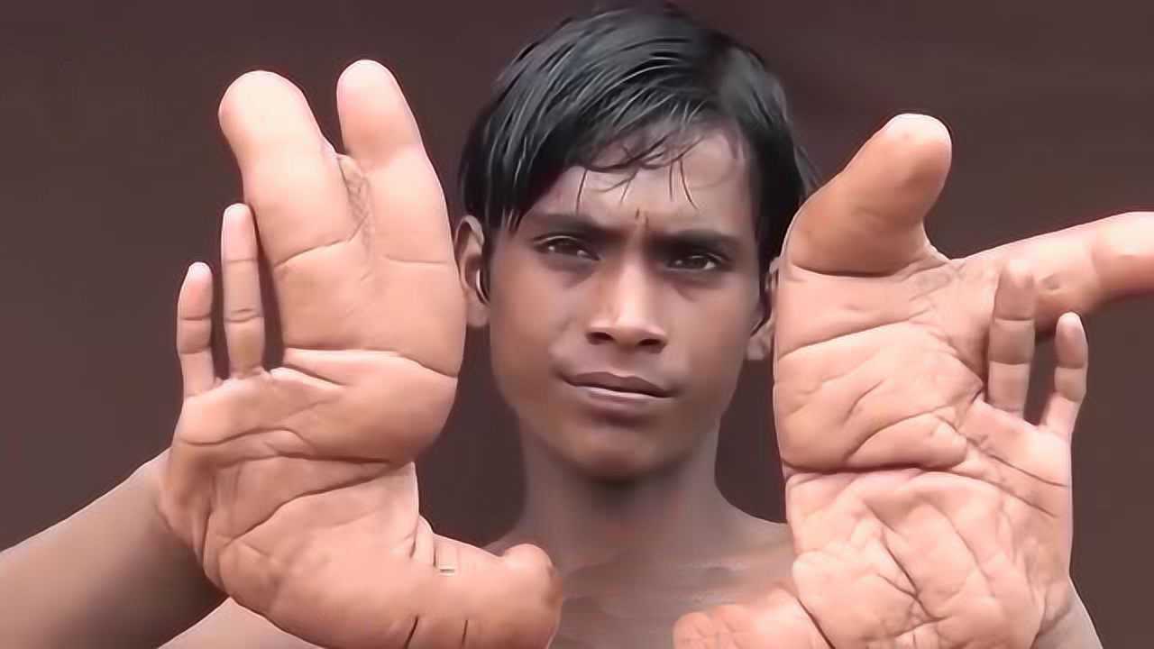 世界最大手掌,印度男孩身患怪病,一巴掌可以把你呼上天