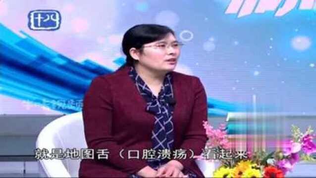 口腔小常识:口腔溃疡更多的表现胃痛,地图舌并无明显痛觉