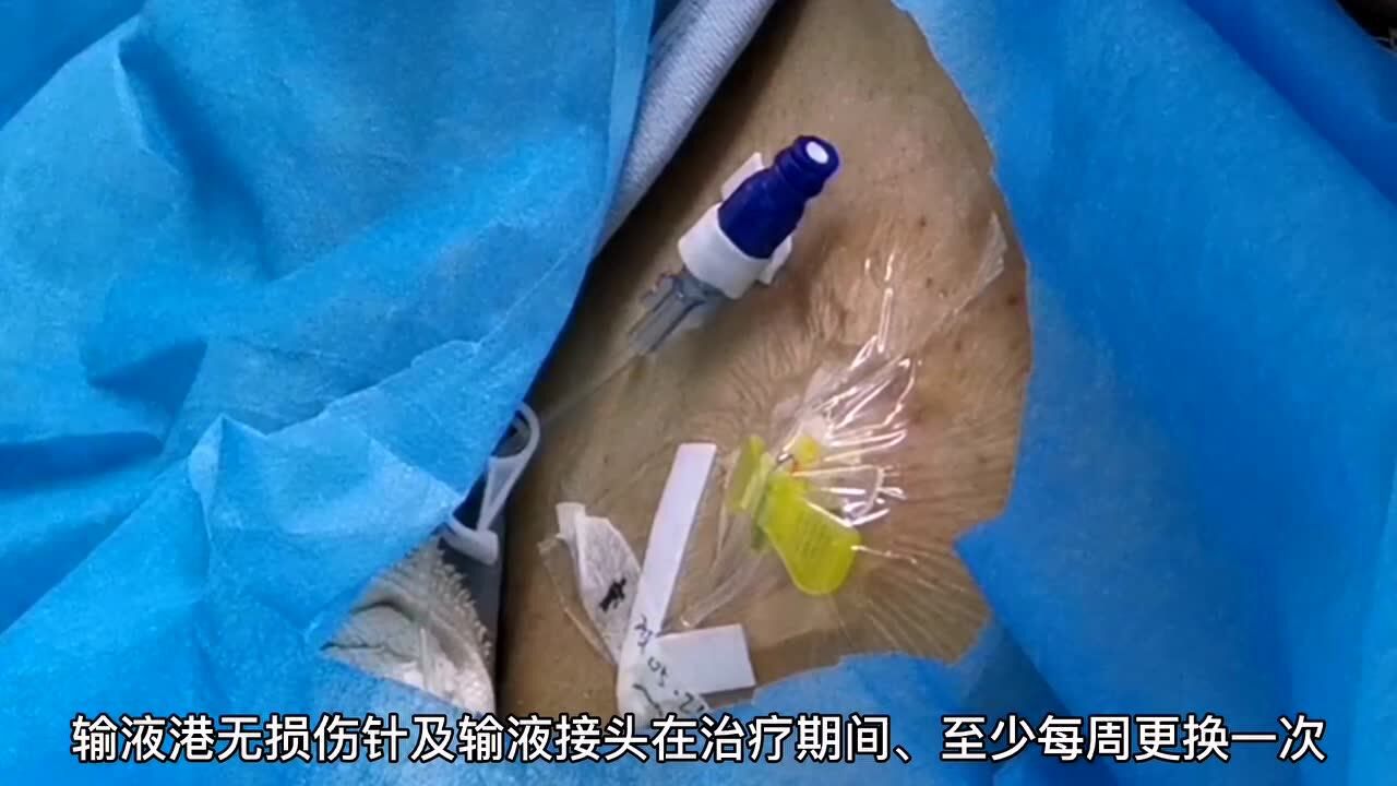 静脉输液港PORT留置无损伤针的流程方法_高清