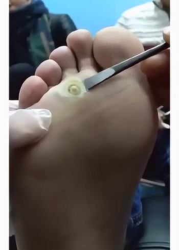 鸡眼割掉的时候,是真的很舒服.你们都是怎么做的.