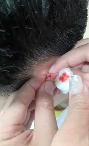 耳尖点刺放血(春成小儿推拿)