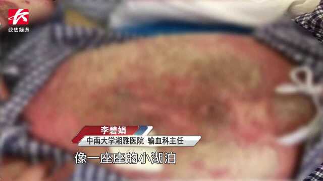 可怕!男子网购“苗药”治牛皮癣,4年后全身流脓差点没命