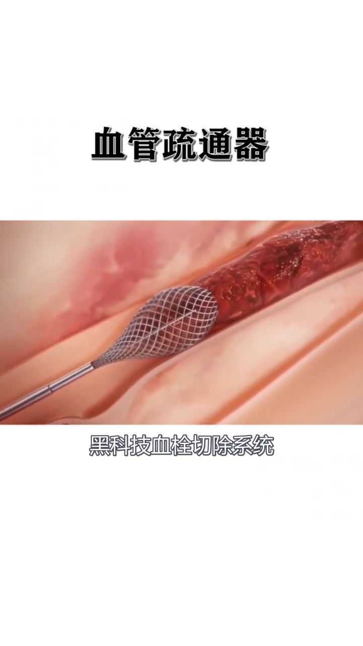 黑科技血管疏通器,轻轻松松清除血管中的血栓