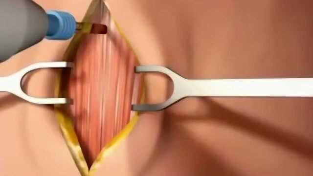 手术用的气管是怎么插进去的,3D动画告诉你答案,就算是这样看着也疼!