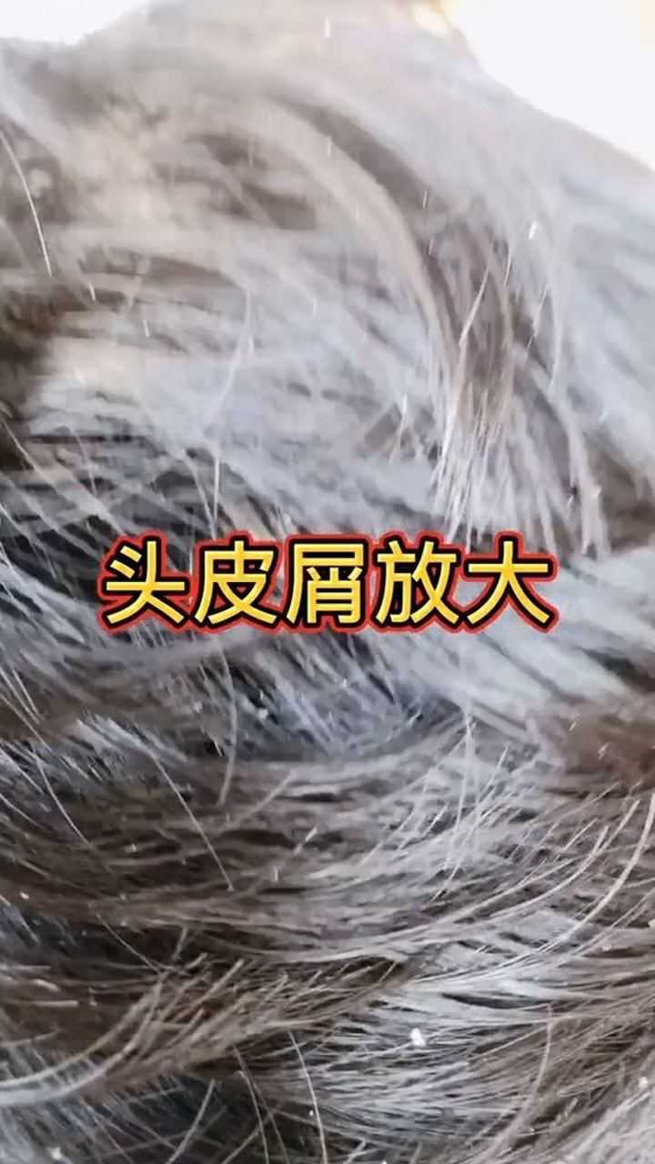 显微镜下的头皮屑.