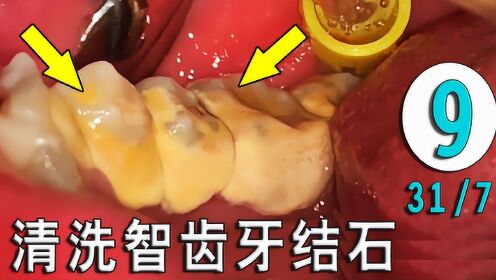 智齿和磨牙有牙垢怎么办?清除牙结石疼吗?这组操作找到答案!