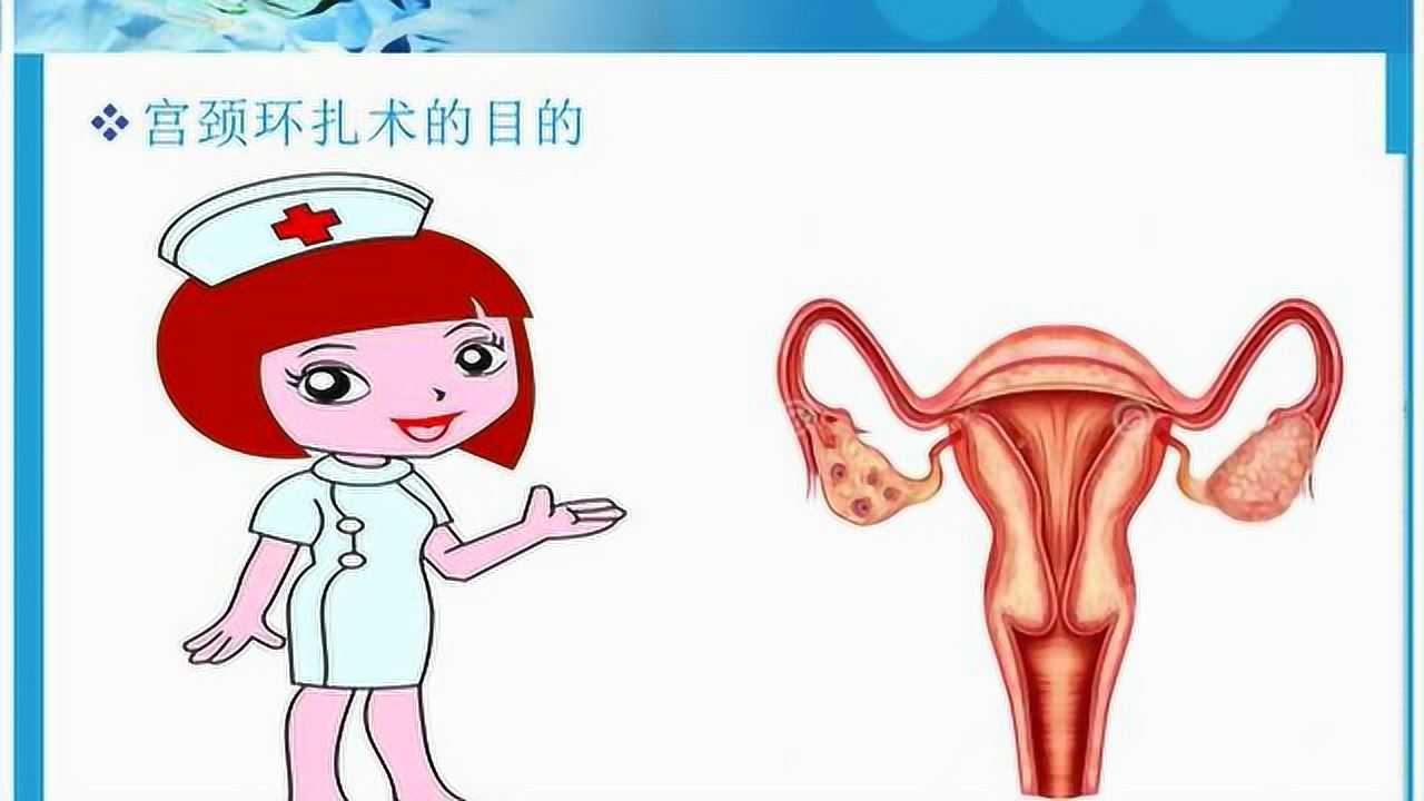 宫颈环扎术动画图片