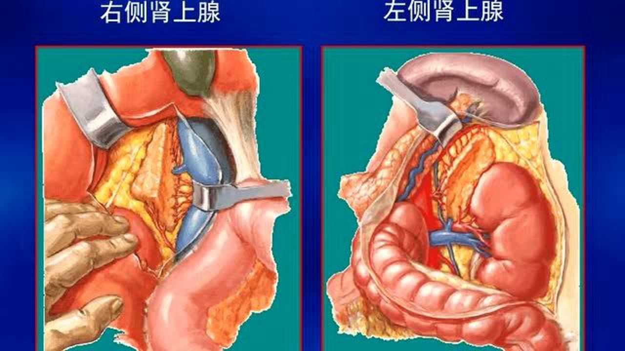 肾上腺肿瘤及瘤样病变的影像诊断