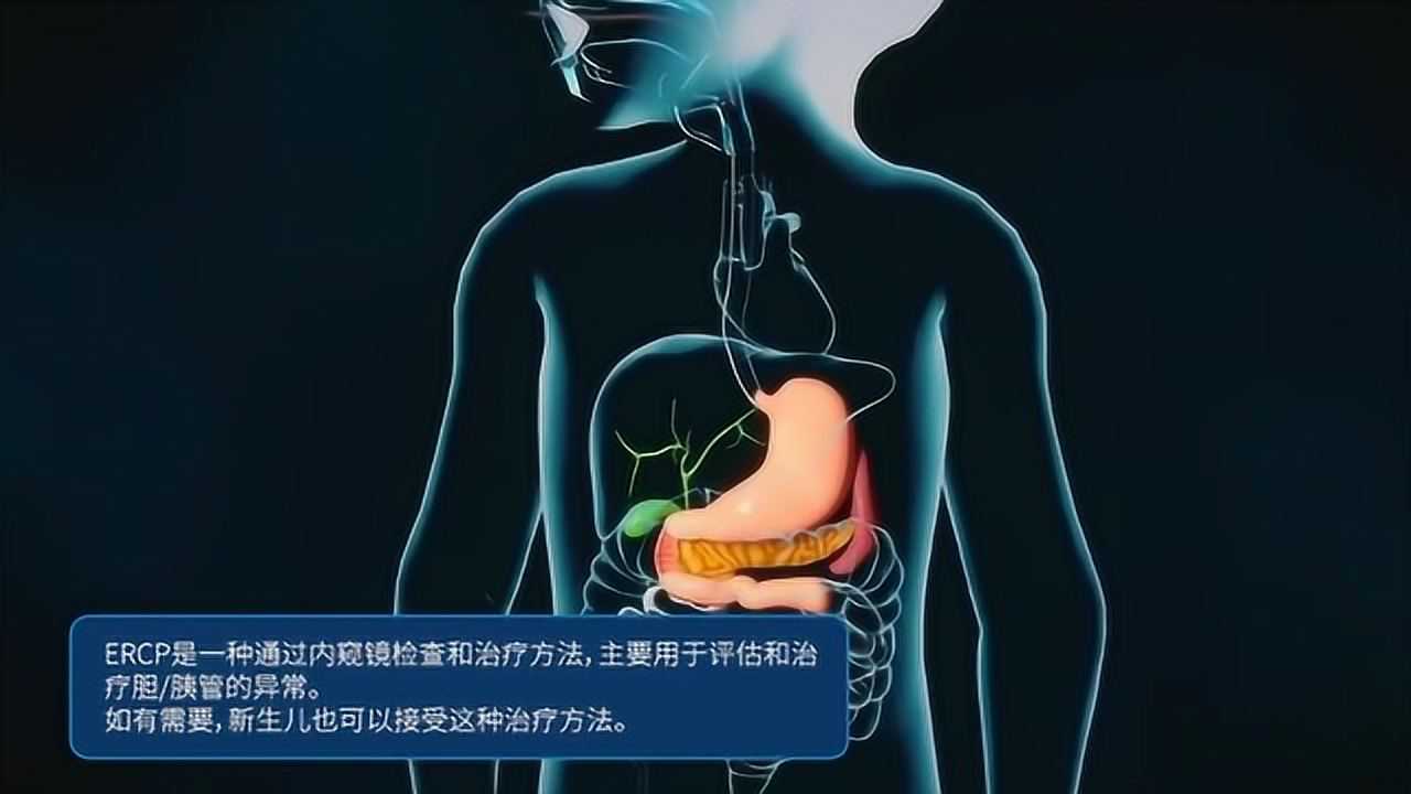 医学动画:ercp治疗胆结石和胰管狭窄_腾讯视频