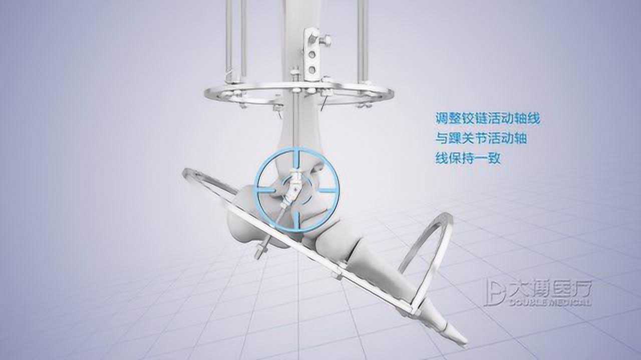 ilizarov环形外固定支架