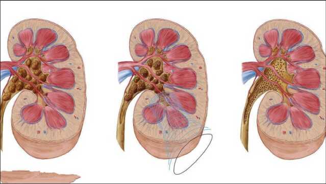 肾结石有哪些信号,得了肾结石一定要碎石吗?怎么治疗效果好?