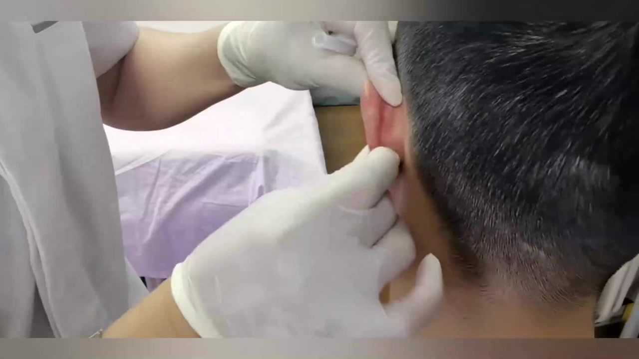 李松芝落藏腹针耳尖刺血治疗头晕耳鸣眼睛模糊