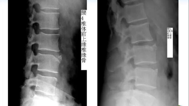 椎缘骨与软骨结节的影像表现喀什地区第一人民医院戴国朝