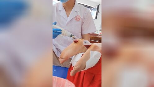 中医刺络放血疗法视频教程,拔罐刺血操作演示_高清1080P在线观看平台_腾讯视频